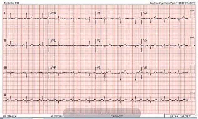 A 12-lead electrocardiogram (ECG) recorded at a standard paper speed of 25 mm/sec and calibration of 10 mm/mV. The tracing demonstrates low QRS voltage throughout both the limb leads (I, II, III, aVR, aVL, aVF) and the precordial leads (V1–V6). In the precordial leads specifically, there is notable 'poor R wave progression' (PRWP), characterized by the failure of the R wave amplitude to increase appropriately from V1 through V4. Instead of the typical transition to a dominant R wave by lead V3 or V4, the R waves remain stunted and small across the chest leads. These findings are clinically significant as they can be associated with various conditions including prior anterior myocardial infarction, cardiomyopathy, pulmonary disease (e.g., COPD), or technical factors like obesity or improper lead placement. The rhythm appears to be sinus, and the baseline shows no significant ST-segment or T-wave abnormalities in this view.