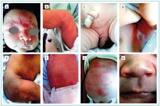 A composite of eight clinical photographs (A-H) demonstrating various common neonatal dermatoses. (A) Shows a salmon patch (nevus simplex), appearing as a midline, flat, reddish-purple vascular macule on the forehead and glabella. (B, E) Exhibit physiological desquamation and erythema of the extremities, characterized by dry, peeling skin and flaky textures. (C) Displays a clamped umbilical cord stump and neonatal genitalia. (D) Shows intertriginous erythema with possible excoriation in a skin fold. (F) Depicts generalized erythema with prominent horizontal skin creases, often seen in vernix caseosa or physiological skin shedding. (G) Shows scattered erythematous macules and papules consistent with erythema toxicum neonatorum. (H) Provides a close-up of milia, presenting as multiple, 1-2 mm pearly white or yellowish subepidermal keratin cysts on the nose and upper lip. This educational resource illustrates normal physiological skin changes and benign transient dermatoses in the newborn period, useful for pediatric clinical training.