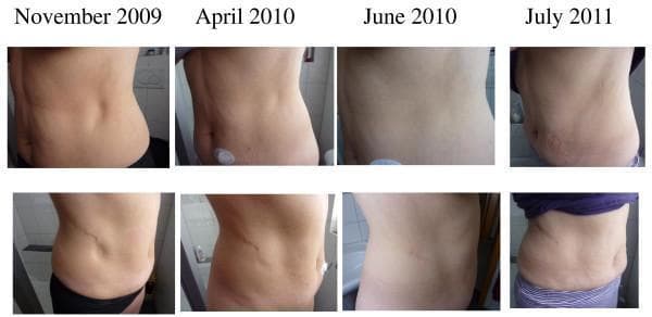 This clinical photographic timeline documents the progression and resolution of insulin-induced lipoatrophy in a 53-year-old female patient with type 1 diabetes. The series consists of eight panels arranged in two rows, comparing lateral and anterolateral views of the abdominal wall over four time points: November 2009, April 2010, June 2010, and July 2011. Initially, in November 2009, deep, well-demarcated cutaneous depressions and hollows are visible at previous insulin pump catheter insertion sites, indicating localized loss of subcutaneous adipose tissue. By April and June 2010, during and after low-dose prednisone therapy, these defects show progressive refilling and reduction in depth, with a return to a more even abdominal contour. The final images from July 2011 demonstrate clinical resolution of the lipoatrophic sites with some residual superficial skin wrinkling and laxity. The images illustrate the clinical presentation of lipoatrophy as a complication of subcutaneous insulin infusion and its response to corticosteroid treatment, emphasizing dermatological assessment in diabetic care.