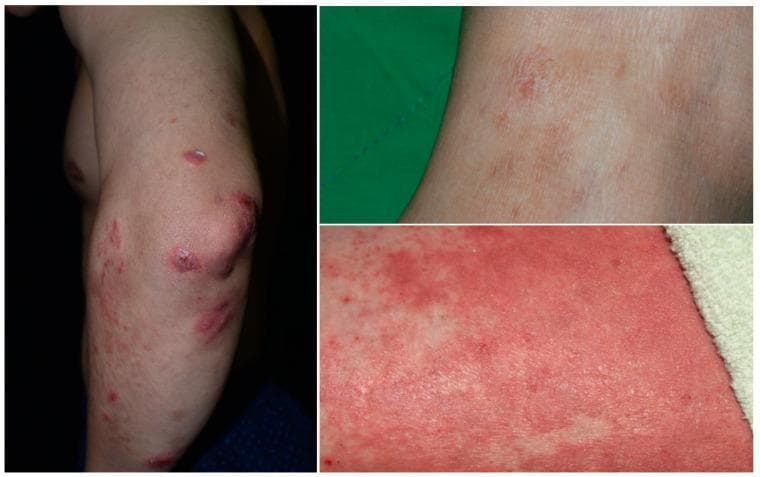 Clinical photographs depicting a patient with overlapping features of psoriasis and atopic dermatitis. The primary image shows the extensor surface of the arm and elbow, displaying multiple well-demarcated, erythematous, thick scaly plaques characteristic of psoriasis. These plaques are distributed predominantly around the olecranon and forearm. In contrast, the high-magnification close-up images reveal areas of more diffuse, poorly defined erythema and fine, granular papules without the heavy micaceous scaling typical of isolated psoriasis. Some regions exhibit signs of excoriation, crusting, and lichenification, suggesting a pruritic, eczematous component (atopic dermatitis). This visual evidence demonstrates 'PsEma' (psoriasis-eczema overlap), where classic psoriatic morphology coexists with the spongiotic patterns of dermatitis. The images serve as an educational tool for differentiating between pure psoriatic lesions and complex, concurrent inflammatory skin diseases that may require integrated therapeutic approaches.