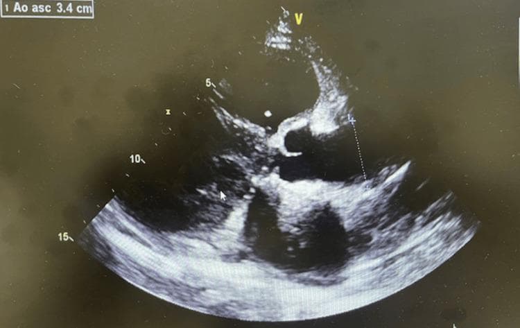 This diagnostic image is a transthoracic echocardiogram in a parasternal long-axis view, demonstrating significant structural cardiac abnormalities. The visual highlights include marked ventricular dilation and thickening of the ventricular walls, consistent with ventricular hypertrophy. An annotation in the upper left corner, 'Ao asc 3.4 cm', indicates a measurement of the ascending aorta's diameter. The cardiac chambers appear enlarged, and the myocardium exhibits increased echogenicity. This imaging provides evidence of chronic heart remodeling, often associated with systemic conditions such as systemic lupus erythematosus (SLE) or hypertensive heart disease, resulting in congestive heart failure. The image serves as a clinical example of structural heart changes secondary to long-term inflammatory or hypertensive disease, facilitating the study of cardiomyopathy and aortic root evaluation via ultrasound.