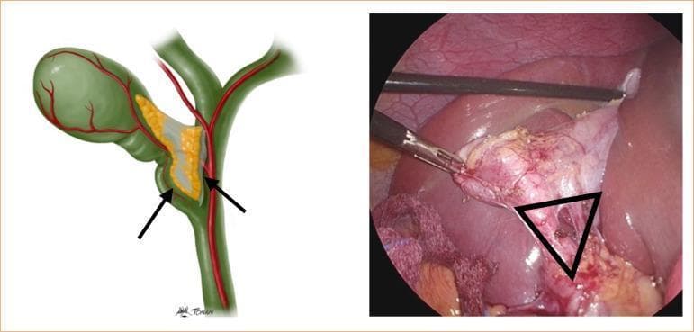 This composite image consists of an anatomical illustration and a corresponding endoscopic photograph demonstrating the landmarks of Calot's triangle (hepatocystic triangle) during a laparoscopic cholecystectomy. The anatomical diagram on the left illustrates the gallbladder, cystic duct, and common hepatic duct (marked with arrows), with the cystic artery passing through the triangle. The laparoscopic view on the right displays the surgical field with laparoscopic graspers retracting a distended, erythematous gallbladder. A black triangular overlay identifies Calot’s triangle, bounded superiorly by the inferior margin of the liver, laterally by the cystic duct, and medially by the common hepatic duct. The operative photograph shows evidence of inflammatory changes, including tissue hypervascularity and edema, which can obscure clear identification of biliary structures. This visual is designed to teach the 'critical view of safety' by emphasizing the anatomical boundaries required to prevent iatrogenic bile duct injuries during minimally invasive hepatobiliary surgery.