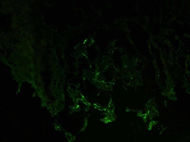 This diagnostic image is a direct immunofluorescence (DIF) micrograph of a renal biopsy specimen. It shows positive staining for IgA antibodies within a glomerulus. The fluorescence pattern is characterized by granular, segmental deposits primarily localized in the mesangium, creating a scattered apple-green signal against a dark, non-reactive background. The distribution is discontinuous and varies in intensity, which is a hallmark finding in IgA nephropathy (Berger's disease). The image illustrates the specific immunological deposition that leads to glomerular injury, highlighting the importance of immunofluorescence in differentiating various types of glomerulonephritis. Key educational concepts include the recognition of mesangial immune complex deposition and the diagnostic utility of antisera specific for immunoglobulin subclasses in nephropathology.