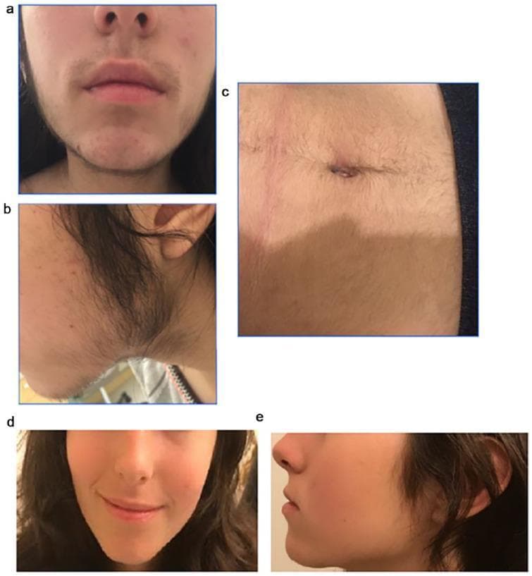 A series of clinical photographs documenting a case of severe hirsutism and its response to treatment. Panels (a) and (b) show the patient at presentation, demonstrating dense, dark terminal hair growth on the upper lip, chin, and submandibular region (jawline) extending toward the preauricular area, consistent with a high Ferriman-Gallwey score. Panel (a) also shows evidence of mild inflammatory acne on the cheeks. Panel (c) displays significant terminal hair growth on the abdomen, both supraumbilical and infraumbilical. Panels (d) and (e) provide a follow-up comparison at 6 months after pharmacological intervention, showing a dramatic clinical reduction in facial terminal hair density and improvement in skin texture. This comparison illustrates the visual manifestation of hyperandrogenism and the efficacy of hormonal management in reversing androgen-dependent hair patterns in female patients.