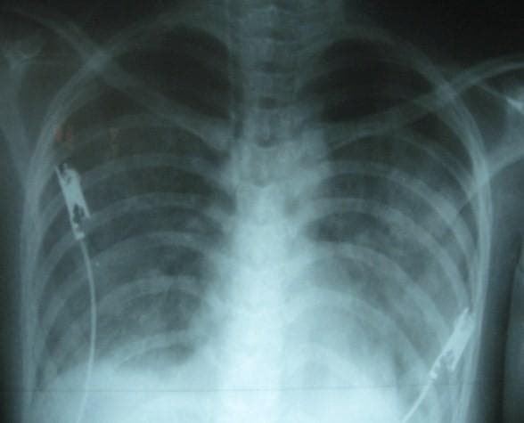 This diagnostic image is an anteroposterior (AP) chest X-ray demonstrating severe pulmonary edema and pleural effusion in a 19-year-old female patient with Dengue Shock Syndrome. The lung fields show bilateral, diffuse, fluffy opacities and increased interstitial markings, characteristic of pulmonary edema. There is significant blunting of the right costophrenic angle, indicating a right-sided pleural effusion. The cardiac silhouette appears moderately enlarged, and the normal clear visualization of pulmonary vasculature is obscured by interstitial and alveolar infiltrates. ECG electrodes and leads are visible on the chest wall, reflecting an acute clinical monitoring setting. This imaging serves as a critical educational example of 'third space' fluid accumulation and capillary leak syndrome secondary to viral hemorrhagic fever, illustrating the rapid progression of respiratory distress during fluid resuscitation in Dengue Shock Syndrome.