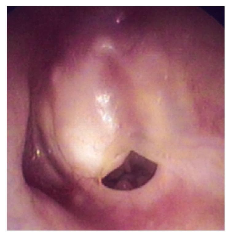This clinical photograph, obtained via otomicroscopy, shows the left tympanic membrane. The membrane exhibits significant pathological changes, characterized by a thickened, opaque, and whitish appearance consistent with tympanosclerosis or chronic inflammatory changes. A well-defined, subtotal perforation is visible in the inferior portion of the membrane. The edges of the perforation appear dry and stable, with no evidence of acute infection, active otorrhea, or visible discharge. The surrounding external auditory canal tissue appears healthy and non-inflamed. Clinically, this visual finding is associated with a history of chronic otitis media and may be an otoscopic manifestation of underlying middle ear pathology, such as a cholesterol granuloma as indicated by the patient's clinical history of hearing loss and otalgia.