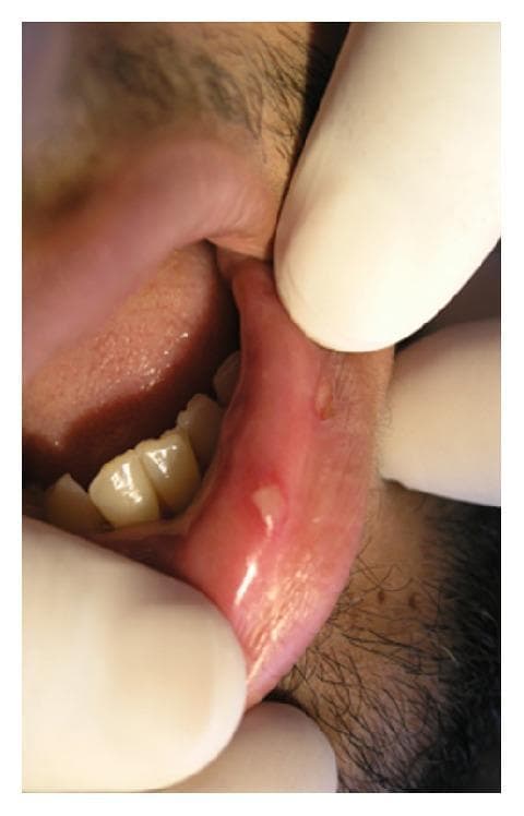 This clinical photograph displays intraoral imaging of the lower labial mucosa, demonstrating the classic presentation of recurrent aphthous stomatitis (RAS). Two distinct, small, round-to-oval ulcers are visible on the non-keratinized inner lining of the lip. The primary lesion is centrally located and characterized by a well-demarcated, yellowish-white pseudomembranous base consisting of fibrin. It is surrounded by a prominent, symmetrical erythematous halo, indicating localized inflammation. A secondary, smaller ulcer with similar morphology is noted more distally on the mucosa. The surrounding tissue appears moist and glistening. Such lesions are typical of minor aphthous ulcers, commonly known as canker sores, which are self-limiting but painful. This image serves as an educational example for diagnosing common inflammatory oral mucosal diseases based on morphological features like the fibrin-covered base and peripheral inflammatory redness.