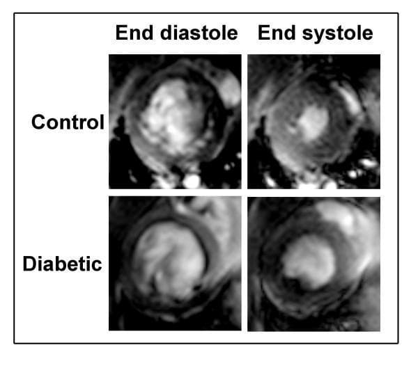 A 2x2 grid of cardiac MRI scans presenting short-axis cine images of the left ventricle (LV) in a rodent model of diabetic cardiomyopathy. The top row displays 'Control' subjects and the bottom row displays 'Diabetic' subjects. The columns categorize the cardiac cycle phases: 'End diastole' (maximum relaxation/filling) on the left and 'End systole' (maximum contraction/emptying) on the right. In the control group, there is a marked reduction in the high-signal (bright) blood pool area from diastole to systole, indicating robust ejection fraction. In the diabetic group, the LV end-diastolic volume appears smaller than the control, while the end-systolic volume appears relatively larger, suggesting impaired contractility and altered cardiac geometry characteristic of diabetic heart disease. The high-resolution imaging demonstrates clear contrast differentiation between the bright ventricular blood pool and the darker, surrounding myocardial wall. This image serves as a diagnostic comparison of ventricular function and volumetric changes across the cardiac cycle in a pathological model.