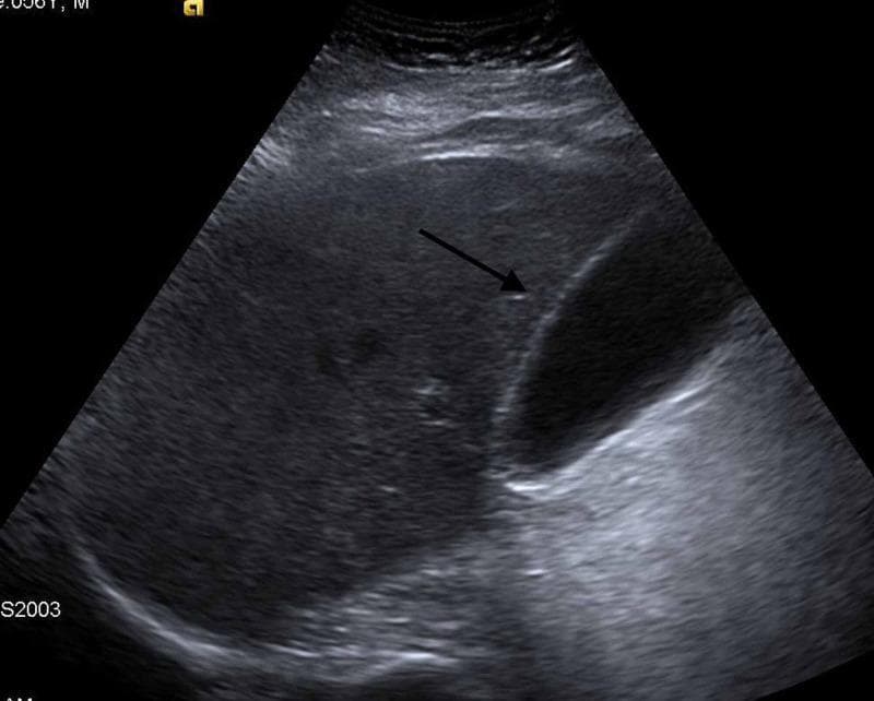 This abdominal ultrasound image shows a longitudinal view of the gallbladder and adjacent liver parenchyma. The gallbladder appears as a clear, ovoid, anechoic (black) structure, indicating it is filled with fluid (bile) without internal echoes, which is consistent with the absence of cholelithiasis (gallstones) or sludge. The gallbladder wall is thin and hyperechoic (bright), showing no signs of thickening or pericholecystic fluid, which helps rule out acute cholecystitis in a clinical setting of abdominal pain. The liver parenchyma exhibits a normal, homogeneous intermediate echogenicity. Posterior acoustic enhancement is visible behind the anechoic gallbladder, a common artifact of fluid-filled structures. This diagnostic image is used to evaluate the biliary system in patients presenting with symptoms such as epigastric or right upper quadrant pain, particularly to differentiate between biliary etiologies and other conditions like acute pancreatitis.