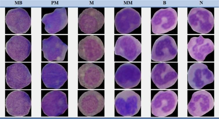 This composite diagnostic image displays a comparison chart of hematological cells from non-cancerous bone marrow aspirations, organized to show the maturation stages of the myeloid series. The visual consists of a grid with six columns, each representing a specific stage of development: Myeloblast (MB), Promyelocyte (PM), Myelocyte (M), Metamyelocyte (MM), Band (B), and Neutrophil (N). The cells are stained with Giemsa, revealing characteristic morphological changes in nuclear and cytoplasmic structure. Early stages (MB, PM) show large, round to oval nuclei with high nuclear-to-cytoplasmic (N:C) ratios and basophilic cytoplasm. As maturation progresses through the Myelocyte and Metamyelocyte stages, the nuclei become smaller and more indented. The Band (B) stage is characterized by an elongated, curved, non-segmented nucleus. The terminal stage, the Neutrophil (N), demonstrates distinct nuclear lobulation (typically 2-3 lobes) and increased cytoplasmic granularity. This image serves as an educational reference for identifying white blood cell precursors in the context of healthy hematopoiesis and chronic myelogenous leukemia (CML) classification.
