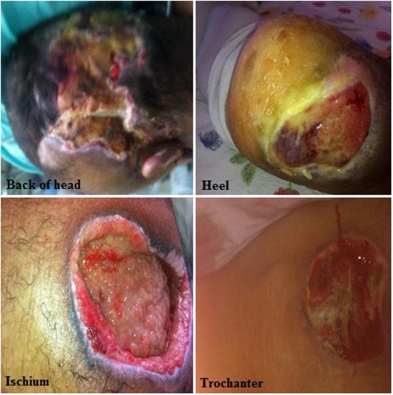 This composite clinical photograph displays four examples of pressure ulcers (PUs) at common anatomical locations: the back of the head, heel, ischium, and trochanter. The images illustrate varying stages of tissue damage. The 'Back of head' photograph shows a large, irregular ulcer with a mix of red granulation tissue, yellow slough, and dark necrotic areas. The 'Heel' ulcer demonstrates a thick, yellowish layer of slough or eschar with peripheral erythema. The 'Ischium' ulcer is a deep, cavitated wound featuring prominent beefy red granulation tissue and well-defined, raised inflammatory borders. The 'Trochanter' image shows a shallower ulceration with central slough and surrounding skin maceration and erythema. Collectively, these images serve as an educational resource for identifying decubitus ulcers over bony prominences, emphasizing variability in wound morphology, tissue composition (slough, granulation, necrosis), and wound depth (Stages II-IV) in patients with compromised mobility.