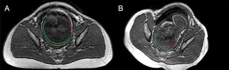 This comparative diagnostic image features two axial MRI scans (A and B) illustrating fetal head molding during labor within the maternal pelvis. Scan A (pre-labor) shows a normal, rounded fetal skull contour with continuous alignment between the occipital bone (annotated in red), parietal bones (green), and frontal bones (blue), indicating open sutures and fontanelles. Scan B (second stage of labor) demonstrates significant mechanical deformation as the fetal head descends through the pelvic brim. In scan B, the fetal skull exhibits a characteristic 'sugarloaf' or elongated appearance. Key visual findings include overlapping of the cranial bones: the parietal bone shifts relative to the occipital bone, and the frontal bone overlaps the parietal bone. These changes indicate the closure of the lambdoid and coronal sutures and reduction of the fontanelles to accommodate the birth canal. The image highlights the physiological flexibility of the fetal cranium and provides clinical evidence of head molding dynamics during active childbirth, useful for obstetric and radiological education.