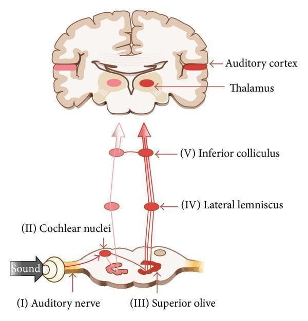 This medical illustration depicts the afferent auditory pathway and the neural generators of the auditory brainstem response (ABR). The diagram follows the sequential ascent of sound signals from the peripheral receptor to the cerebral cortex. The pathway initiates at the Auditory Nerve (I), proceeding to the Cochlear Nuclei (II) in the brainstem. The signal continues through the Superior Olive (III), ascends via the Lateral Lemniscus (IV), and reaches the Inferior Colliculus (V) in the midbrain. From the midbrain, the pathway is shown projecting to the Thalamus (medial geniculate nucleus) and finally to the primary Auditory Cortex located on the superior temporal gyrus. The top portion of the figure includes a coronal cross-section of the brain to contextualize the cortical and subcortical destinations. The diagram is designed for educational purposes in neurology and otolaryngology, illustrating the hierarchical processing stages involved in auditory perception and clinical diagnostic testing like ABR.
