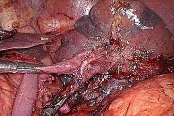 This clinical photograph captures an intraoperative view during a surgical procedure involving the splenic hilum, likely a laparoscopic gastrectomy or splenectomy. The image provides a detailed view of the vascular anatomy after skeletonization. The splenic artery (sa) and splenic vein (sv) are clearly identified as they approach the hilum of the spleen, which appears as a large, dark, parenchymal organ in the background. The splenic vein is positioned inferior to the splenic artery. A surgical instrument is seen grasping and retracting tissue to better expose these hilar structures. In the adjacent field, the liver and other dissected retroperitoneal tissues are visible. The field shows evidence of surgical manipulation, including fragmented connective tissue and minor blood staining, illustrating the precise dissection required for lymphadenectomy (such as No. 10 splenic hilar nodes) or vascular control. This visual serves as an educational resource for identifying the anatomical relationship between major splenic vessels and the tail of the pancreas within the retro-pancreatic space.