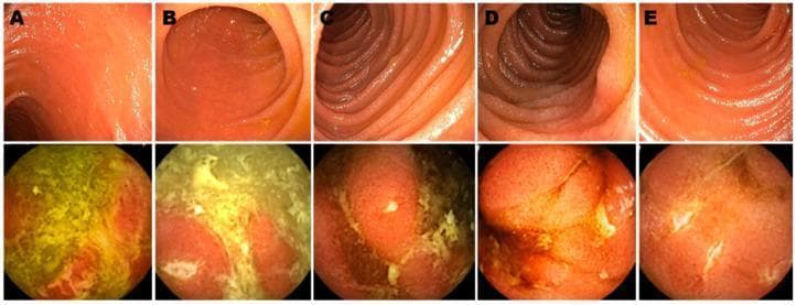 This Comparison Chart features a series of endoscopic images labeled A through E, contrasting traditional ileo-colonoscopy (upper panels) with wireless capsule endoscopy (WCE, lower panels) in post-operative Crohn's disease patients. The upper panels display the terminal ileum with a relatively smooth, pinkish mucosal surface and regular vascular patterns, consistent with endoscopic remission (Rutgeerts scores i0-i1). In contrast, the lower panels show WCE images of the proximal small bowel from the same patients, revealing significant pathological changes. These abnormalities include patchy erythema, friable mucosa, and prominent white or yellowish inflammatory exudates and fibrinous deposits. Linear ulcerations and cobble-stoning texture are visible in frames B and E, indicating active Crohn's recurrence. The comparison demonstrates the clinical utility of WCE in detecting proximal small bowel inflammation that may be missed by standard colonoscopy, emphasizing the importance of small bowel evaluation in disease staging and postoperative monitoring.