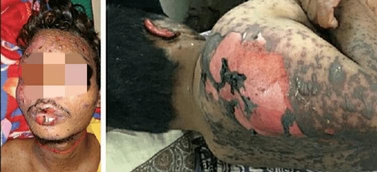 Clinical photograph of a patient exhibiting severe dermatological manifestations of Toxic Epidermal Necrolysis (TEN). The visual evidence includes extensive epidermal detachment and desquamation across the face, neck, and upper torso. On the face, there is significant mucosal involvement with hemorrhagic crusting and erosions of the lips, along with scattered vesiculobullous lesions on the cheeks and forehead. The lateral and posterior views of the upper body demonstrate large areas of denuded skin where the epidermis has sloughed off, revealing erythematous, raw dermis. Bordering these areas are gray-tinged, necrotic skin flaps and multiple scattered dusky macules and bullae. This presentation is characteristic of a severe cutaneous adverse reaction (SCAR), showing a positive Nikolsky sign where skin peels in large sheets. The distribution is generalized, involving both mucosal surfaces and a high percentage of total body surface area, illustrating the critical nature of the condition typically associated with drug-induced hypersensitivity.