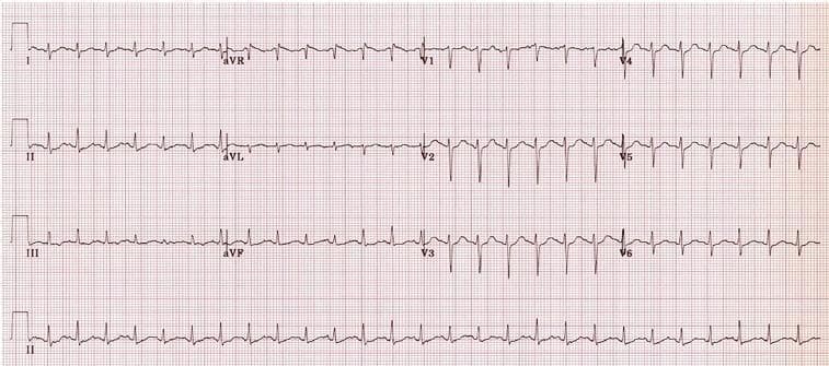 A 12-lead electrocardiogram (ECG) displayed in a standard 3x4 grid with a long Lead II rhythm strip at the bottom. The tracing exhibits a sinus tachycardia with a heart rate exceeding 100 beats per minute. P-waves are upright in leads I, II, and aVF, and inverted in aVR, indicating a normal sinus origin. The PR intervals and QRS durations appear within normal physiological limits. In the precordial leads (V1-V6), there is normal R-wave progression, characterized by small R-waves and deep S-waves in V1-V2, transitioning to dominant R-waves in V5-V6. The ST segments are largely isoelectric across all leads without evidence of acute ST-elevation myocardial infarction (STEMI) or significant depression. T-waves appear concordant and of normal morphology. This ECG serves as a diagnostic tool in the clinical context of systemic illness, such as metabolic disturbances or acute poisoning, to assess cardiac rhythm, rate, and potential toxicological effects on cardiac conduction.