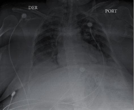 This diagnostic image is a portable anteroposterior (AP) chest X-ray of an adult patient. The primary radiographic findings include extensive, bilateral interstitial and alveolar infiltrates across both lung fields, consistent with Acute Respiratory Distress Syndrome (ARDS) or multifocal pneumonia. There is a dense, focal area of consolidation in the right basal lung region, likely representing localized infectious consolidation or atelectasis. Multiple medical devices are visible: a port catheter (labeled 'PORT') is present in the left upper chest with its tip directed centrally, and a separate lead system (marked 'DER' for right) with surface electrodes is visible for cardiac monitoring. The diaphragmatic contours are somewhat obscured by the basal opacities, and the cardiac silhouette appears enlarged, though evaluation is limited by the AP technique. Clinically, these findings are highly relevant for diagnosing severe lower respiratory tract involvement in systemic viral or bacterial infections, such as SARS-CoV-2 pneumonia complicated by superinfection.