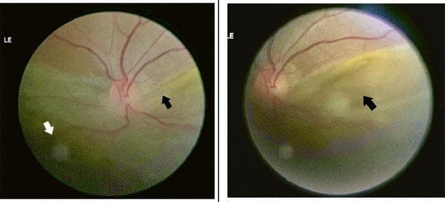 Two side-by-side posterior segment fundus photographs of a left eye demonstrating a rhegmatogenous retinal detachment (RRD) and dialysis of the ora serrata. The images show a clear demarcation between the superiorly attached pinkish-orange retina and the inferiorly detached retina, which appears elevated, pale, and somewhat hazy. The detachment involves the macula (macula-off), which is clinically significant for severe central vision loss. A black arrow points to the leading edge of the subretinal fluid and retinal elevation. A white arrow highlights a dialysis of the ora serrata located in the inferior temporal quadrant, visible as a peripheral retinal break where the retina has disinserted from its base. The optic disc and major retinal vasculature are visible, with the blood vessels seen traversing both the attached and detached portions of the fundus. These clinical findings are characteristic of a primary retinal detachment secondary to spontaneous or traumatic peripheral retinal dialysis.