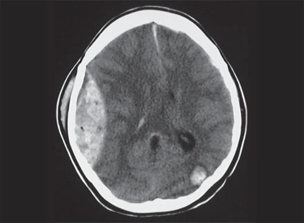 This diagnostic image is an axial non-contrast CT scan of the brain demonstrating acute traumatic intracranial pathology. The primary finding is a large, biconvex (lentiform), hyperdense collection in the right frontoparietal region, characteristic of an acute extradural (epidural) hemorrhage. The lesion is well-defined and exerts a significant mass effect, resulting in the inward compression of the adjacent brain parenchyma and effacement of the ipsilateral cortical sulci. Additionally, a secondary focal area of hyperdensity is visible in the left occipital region, consistent with a hemorrhagic contusion, often occurring as a contre-coup injury in the setting of head trauma. Subgaleal swelling is also noted on the right side of the cranium. These findings are critical for medical students and radiology residents to differentiate between extra-axial hemorrhages, where the biconvex shape of an epidural hematoma—limited by cranial sutures—is contrasted with the crescent-shaped presentation of subdural hematomas.