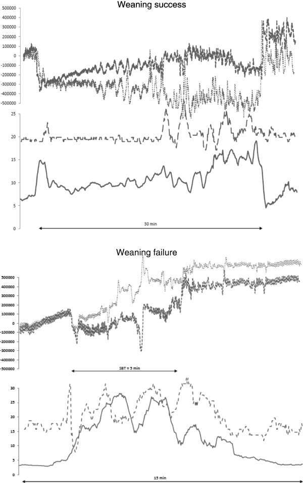 This comparison chart displays physiological waveforms from two patients undergoing a spontaneous breathing trial (SBT) for mechanical ventilation weaning: one who succeeds (top panel) and one who fails (bottom panel). For each patient, three primary respiratory metrics are plotted over time (x-axis): respiratory inductive plethysmography (RIP) tracing thoracic (fine dots) and abdominal (bold dots) bands, respiratory rate (dashed line), and the electrical activity of the diaphragm (EAdimax, solid line). In the weaning success patient, EAdimax and respiratory rate remain relatively stable throughout the 30-minute trial. In contrast, the weaning failure patient exhibits a steep, immediate increase in EAdimax and rapid fluctuations in respiratory rate upon disconnection from the ventilator, leading to trial termination after only 5 minutes. The RIP tracings for the failure patient show more pronounced and rapid oscillations in thoracic and abdominal movement, indicating increased work of breathing and potential recruitment of accessory muscles. This clinical graphic illustrates the use of diaphragmatic electromyography and plethysmography as diagnostic tools to monitor inspiratory effort and predict weaning outcomes in intensive care settings.