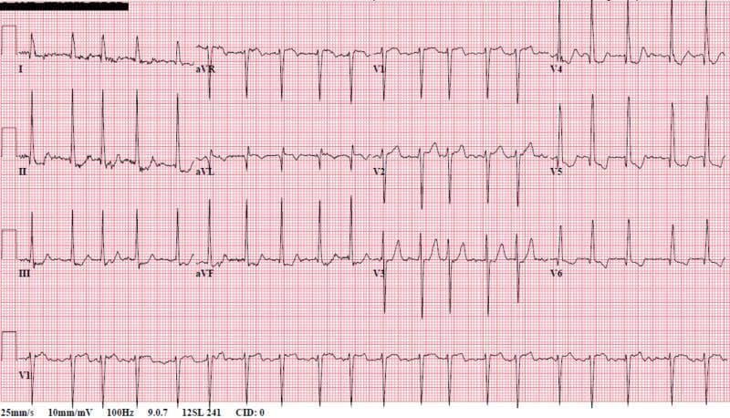 A 12-lead electrocardiogram (ECG) demonstrating a classic irregularly irregular rhythm consistent with atrial fibrillation. The diagnostic image shows absent P waves across all leads, replaced by fine, chaotic baseline fibrillatory waves, most notably visible in lead V1 and the rhythm strip. The R-R intervals are highly variable, with a rapid ventricular response (tachycardia) evident from the frequent QRS complexes. The QRS morphology is relatively narrow (normal duration), indicating supraventricular origin. There is evidence of left axis deviation and voltage criteria suggestive of left ventricular hypertrophy, particularly in the precordial leads V4-V6. Non-specific ST-segment and T-wave changes are observed, which may be secondary to the rapid rate. This ECG is a critical educational tool for identifying disorganized atrial electrical activity and the subsequent irregular ventricular conduction pattern characteristic of AFib with RVR.