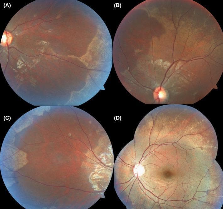 This set of four clinical fundus photographs (A-D) demonstrates the classic Mizuo-Nakamura phenomenon associated with Oguchi disease, a rare form of congenital stationary night blindness. Panels A, B, and C show the light-adapted state of the mid-peripheral retina, characterized by a peculiar, patchy, grayish-white or golden-yellow metallic sheen and discoloration located predominantly outside the retinal vascular arcades. Panel D illustrates the same fundus under increased light exposure or a camera flash, where the golden-yellow reflective sheen becomes more accentuated and widespread. This diagnostic visual finding typically disappears or returns to a normal reddish-brown fundus appearance after several hours of dark adaptation. The images emphasize the dynamic pigmentary changes of the retinal pigment epithelium and photoreceptor layer in response to light, providing a key clinical marker for hereditary retinal dysfunction. The optic disc, macula, and retinal vasculature appear otherwise normal, highlighting the functional rather than structural nature of this specific dystrophy.