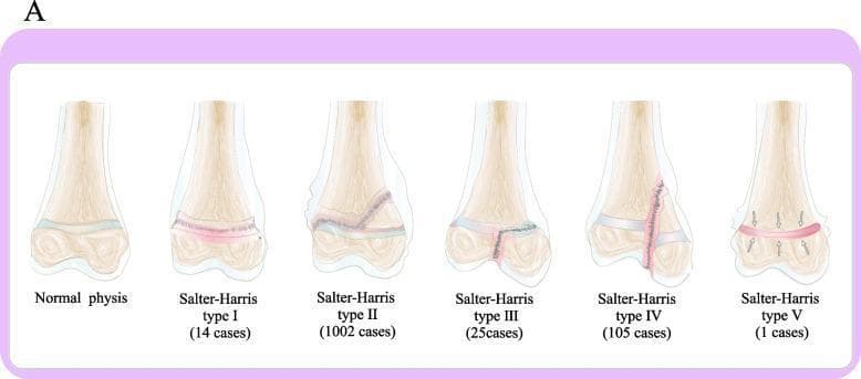 This medical illustration presents the Salter-Harris classification system for pediatric epiphyseal plate fractures, shown on a long bone model. Six diagrams compare the normal anatomy with fracture types I through V. The 'Normal physis' shows an intact growth plate between the metaphysis and epiphysis. Type I is a transverse fracture through the physis. Type II, the most frequent at 1002 cases, travels through the physis and exits through the metaphysis, creating a Thurston-Holland fragment. Type III travels through the physis and exits through the epiphysis into the joint space. Type IV is a vertical fracture crossing the metaphysis, physis, and epiphysis. Type V, the rarest with 1 case, is depicted as a crush or compression injury of the physis indicated by inward-pointing arrows. Each diagram is labeled with the corresponding fracture type and the number of cases from a clinical study, providing a visual guide for orthopedic classification and prevalence in pediatric populations.