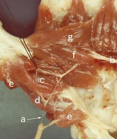 This clinical anatomical photograph displays a deep dissection of the human palm, specifically focusing on the thenar eminence and the neurovascular structures of the thumb. The image highlights the intricate relationship between the intrinsic hand muscles and their nerve supply. Key labeled muscular structures include the superficial head of the flexor pollicis brevis (c), the opponens pollicis (d), and the abductor pollicis brevis (e). Additionally, both the oblique (f) and transverse (g) heads of the adductor pollicis are clearly visible. The neural components are represented by a branch of the median nerve (a), shown providing innervation to the thenar muscles, and the deep branch of the ulnar nerve (b), which courses toward the adductor muscles. This visual serves as an educational tool for understanding hand anatomy, the concept of double innervation in the flexor pollicis brevis, and the surgical landmarks required for procedures involving the thenar space and peripheral nerve mapping.