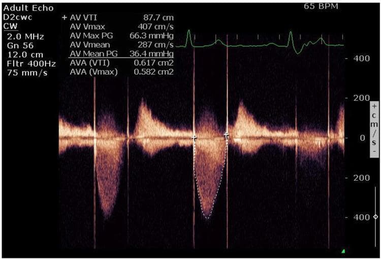 This diagnostic image shows a continuous wave (CW) Doppler spectral tracing from a transthoracic echocardiogram (TTE) focused on the aortic valve (AV). The display exhibits a characteristic high-velocity systolic jet below the baseline, indicating flow away from the transducer, with a dense, filled-in spectral envelope typical of significant valvular stenosis. Superimposed on the display is an ECG rhythm strip showing a heart rate of 65 BPM. Key quantitative hemodynamic measurements for the aortic valve are displayed in the upper-left overlay: Vmax of 407 cm/s, Maximum Pressure Gradient (Max PG) of 66.3 mmHg, and Mean Pressure Gradient (Mean PG) of 36.4 mmHg. The calculated aortic valve area (AVA) is approximately 0.6 cm², suggestive of severe aortic stenosis or prosthetic valve dysfunction. The image serves as a clinical illustration of hemodynamic assessment in valvular heart disease post-thrombolytic therapy (tPA) to evaluate improvement in transvalvular gradients and valve area.
