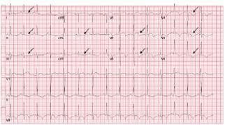 This diagnostic image is a 12-lead electrocardiogram (ECG) printed on standard red-grid paper, demonstrating significant repolarization abnormalities. The tracing shows a normal sinus rhythm with specific T-wave morphology changes annotated by black arrows. Key findings include: deep, symmetric T-wave inversions in the lateral precordial leads (V4, V5, and V6); biphasic T-waves in leads V2 and V3; and T-wave flattening or subtle inversion in the limb leads (I, aVL, II, III, and aVF). These visual patterns, particularly the deep symmetric precordial T-wave inversions and biphasic morphologies in the absence of significant ST-segment elevation, are classic indicators of Wellens' syndrome or myocardial ischemia related to proximal left anterior descending (LAD) coronary artery stenosis. The ECG serves as a critical educational tool for identifying high-risk coronary syndromes and distinguishing ischemic T-wave changes from non-specific repolarization variants.