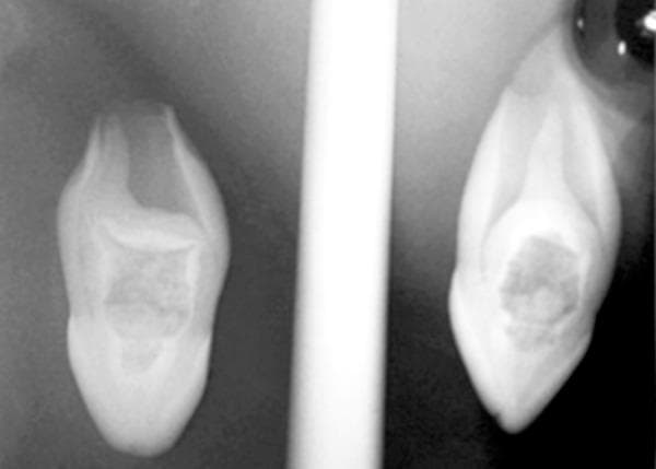 This diagnostic periapical radiograph displays labial and mesial views of a maxillary left lateral incisor (tooth 22) demonstrating complex developmental anomalies. The primary finding is a Oehlers Type III dens invaginatus, characterized by a radiopaque, pouch-like invagination originating from the lingual/palatal surface and extending apically beyond the cemento-enamel junction. This invagination creates a 'tooth within a tooth' appearance with a central radiolucent core. Additionally, the tooth exhibits an abnormally wide pulp chamber containing a large, irregular radiopacity consistent with a pulp stone (denticle), which occupies a significant portion of the internal coronal space. The radiographic features illustrate developmental disturbances in dental morphodifferentiation, specifically invaginated teeth and calcifications within the pulp system, which are clinically significant for endodontic planning and potential periapical pathology.
