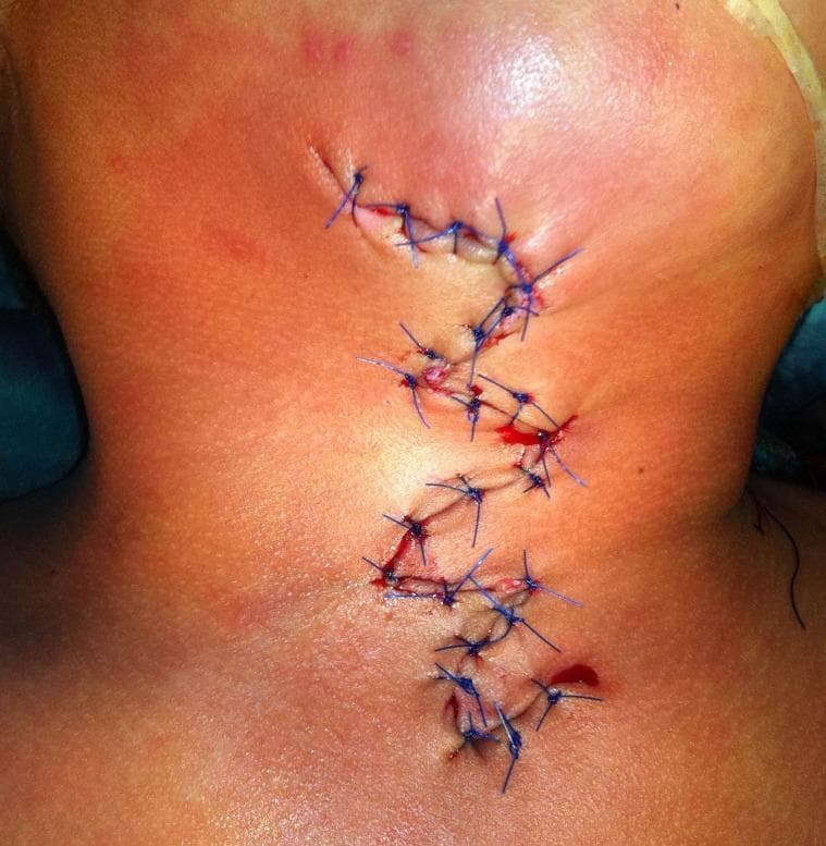 A clinical photograph showing a surgical wound closure on the neck region following a defect excision. The wound is closed using blue, non-absorbable monofilament sutures in an interrupted pattern. The incision follows a zig-zag or serpentine 'Z-plasty' configuration, likely designed to manage tension or minimize contracture during healing. Visible features include approximately 15-20 individual simple interrupted sutures. There is localized erythema (redness) and mild edema (swelling) of the periwound skin, which are typical signs of immediate post-operative inflammation. Small amounts of serosanguinous fluid and fresh blood are visible around several suture exit points. The surrounding skin is fair-toned with mild surface irregularities. This image serves as an educational example of complex surgical wound management and tension-relieving closure techniques in dermatologic or plastic surgery.