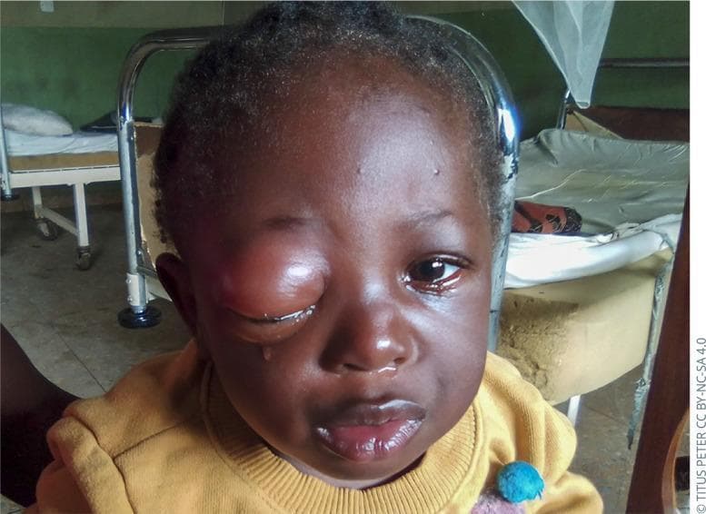 This clinical photograph shows a pediatric patient presenting with severe, unilateral periorbital inflammation of the right eye, consistent with orbital cellulitis. Key features include significant erythematous edema and distension of the upper and lower eyelids, resulting in complete mechanical ptosis and obscuration of the globe. There is visible epiphora (tearing) and evidence of serous discharge along the eyelid margin. The surrounding facial tissues show mild generalized swelling, while the contralateral eye appears unaffected. This image illustrates the typical clinical presentation of acute orbital infection in children, emphasizing the critical need for diagnostic differentiation from preseptal cellulitis to prevent sight-threatening complications such as abscess formation or intracranial spread. The case highlights the importance of monitoring for systemic signs, restricted extraocular motility, and proptosis in pediatric ophthalmology and emergency medicine contexts.