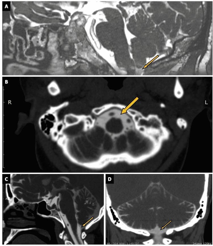 This composite diagnostic image illustrates the cisterna magna across multiple modalities and planes. Panel A shows a sagittal view using 3D constructive interference in steady state (CISS) MRI, where the cistern appears as a dark, hypointense fluid-filled space. Panels B, C, and D utilize CT cisternography in axial, sagittal, and coronal planes, respectively, to visualize the cistern as a region of low attenuation enhanced by contrast material. Anatomically, the cisterna magna is located in the posterior cranial fossa, situated inferior to the cerebellum and posterior to the medulla oblongata. It is identified by arrows in each panel. The images demonstrate the cistern's relationship to surrounding structures, including the brainstem, cerebellar vermis, and the foramen magnum. This visual guide serves as a clinical reference for identifying normal subarachnoid cistern anatomy, which is essential for diagnosing conditions such as CSF rhinorrhea or posterior fossa malformations. The target audience includes medical students and radiology residents specializing in neuroimaging.