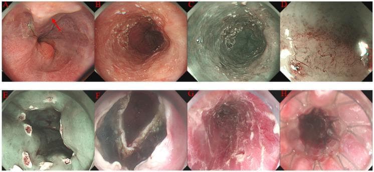 A composite of eight endoscopic images (A-H) demonstrating the stepwise procedure of Endoscopic Submucosal Dissection (ESD) for superficial esophageal cancer. (A) White light imaging shows distal esophageal varices marked with a red arrow. (B-C) Visualization of a superficial 0-IIb esophageal lesion using white light and Narrow Band Imaging (NBI), highlighting mucosal irregularity. (D) Magnifying endoscopy with NBI reveals abnormal intraepithelial papillary capillary loops (IPCL), categorized as type B1 and B2, indicative of squamous cell carcinoma. (E) Circumferential electrocautery marking of the lesion's margins for resection guidance. (F-G) Intra-procedural views showing mucosal/submucosal incision and the final post-resection wound surface (ESD ulcer). (H) Placement of a fully covered self-expanding metal stent (SEMS) within the esophageal lumen following the procedure. This series illustrates advanced therapeutic endoscopy techniques for managing early-stage gastrointestinal malignancies in the context of portal hypertension.