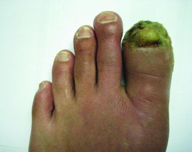 This clinical photograph displays a top-down view of the left foot, specifically highlighting severe pathology of the first toe (hallux). The distal portion of the first toe exhibits total nail plate destruction and a large, infected ulcerated lesion. The ulcer bed presents with a prominent greenish-yellow purulent exudate and areas of necrotic black crusting, suggesting bacterial colonization or secondary infection. The surrounding soft tissue of the first toe is markedly erythematous and edematous. The second, third, and fourth toes show a diffuse reddish-purple discoloration (cyanosis or livedo-like changes) and mild swelling, particularly at the distal phalanges. The nail plates of the remaining toes appear thickened with longitudinal ridges. These visual findings are consistent with thromboangiitis obliterans (Buerger's disease) or severe peripheral vascular disease leading to digital ischemia, gangrene, and secondary paronychia.