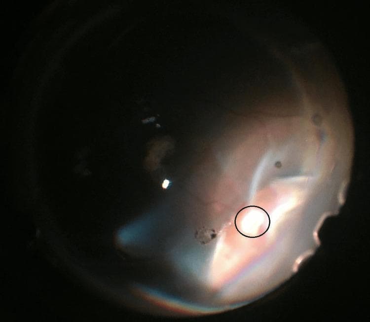 This clinical diagnostic image is an intraoperative fundus photograph demonstrating a rhegmatogenous retinal detachment (RRD) with a significant primary pathology highlighted. Encircled in black is a large, irregularly shaped retinal tear. The defect appears as a well-defined, bright discontinuity in the retinal tissue, revealing the underlying reddish-orange choroid. Associated with this tear is evidence of incarcerated vitreous, appearing as a focal point of traction. The surrounding retina is diffusely pale, opaque, and elevated, characteristic of a bullous retinal detachment. Subtle haziness across the posterior segment suggests subretinal fluid accumulation and mild proliferative vitreoretinopathy (PVR) changes. The imaging illustrates the critical relationship between a full-thickness retinal break and the subsequent development of extensive detachment. This visual is highly relevant for ophthalmology training, specifically in identifying surgical landmarks during pars plana vitrectomy for complex retinal repairs.
