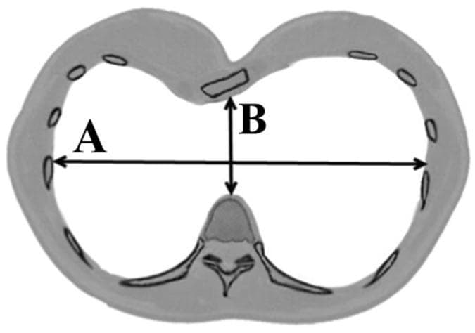 This diagnostic diagram represents an axial (cross-sectional) view of the human thorax, specifically demonstrating the methodology for calculating the Haller index used in evaluating Pectus Excavatum severity. The diagram highlights the skeletal structures of the thoracic cage: the vertebral body is positioned posteriorly, and the sternum is shown anteriorly with a concave depression characteristic of funnel chest. Bilateral ribs define the lateral boundaries of the thoracic cavity. Two primary measurements are labeled: 'A' represents the maximum transverse diameter (laterolateral distance) measured between the inner aspects of the rib cage; 'B' represents the minimum anteroposterior diameter, measured from the posterior surface of the sternal depression to the anterior surface of the vertebral body. The Haller index is mathematically defined as the ratio A/B. This schematic is essential for clinical imaging assessment in thoracic surgery, particularly for pre-operative planning of the Nuss procedure, providing a quantitative measure of chest wall deformity.