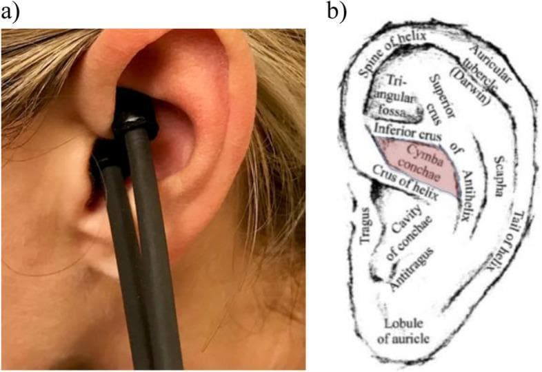 Educational visual regarding transcutaneous auricular vagus nerve stimulation (ta-VNS). Panel (a) is a clinical photograph showing a hand-held bipolar sensor probe applied to a human left ear. The probe's tips are positioned within the cymba conchae, the superior portion of the concha located above the crus of helix. Conductive gel is visible at the point of contact to facilitate electrical transmission. Panel (b) is a detailed anatomical diagram of the left auricle (pinna) labeling major landmarks: helix (spine, tail, and tubercle), antihelix (superior and inferior crus), scapha, triangular fossa, tragus, antitragus, cavity of conchae, and lobule. The cymba conchae is highlighted in red, illustrating its boundaries between the inferior crus of the antihelix and the crus of helix. This area is the primary anatomical target for ta-VNS due to the dense distribution of the auricular branch of the vagus nerve (ABVN). The content is designed for medical training in neuromodulation techniques and clinical neuroanatomy.