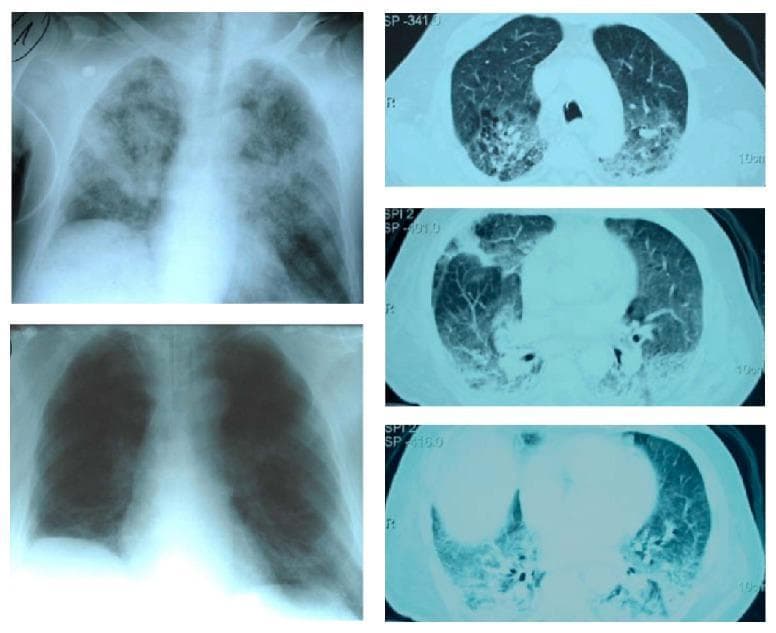 This composite diagnostic image includes chest X-rays and axial CT scans illustrating the progression and resolution of Acute Respiratory Distress Syndrome (ARDS). The top-left anterior-posterior chest X-ray shows diffuse, patchy bilateral alveolar infiltrates and ground-glass opacities in a postoperative patient, characteristic of pulmonary edema. To the right, three axial CT scan slices (cranial to caudal) demonstrate significant bilateral dorsal consolidation and dependent infiltrates with air bronchograms, typical of ARDS morphology. The bottom-left chest X-ray shows the same patient following Continuous Extrathoracic Negative Pressure Ventilation (CENPV), displaying marked regression of the bilateral infiltrates, improved lung aeration, and a reduction in previously noted pleural effusions. The educational focus is on the radiographic monitoring of lung recruitment and the resolution of pulmonary consolidations in critical care. This material is relevant for pulmonary medicine, anesthesia, and intensive care specialties.