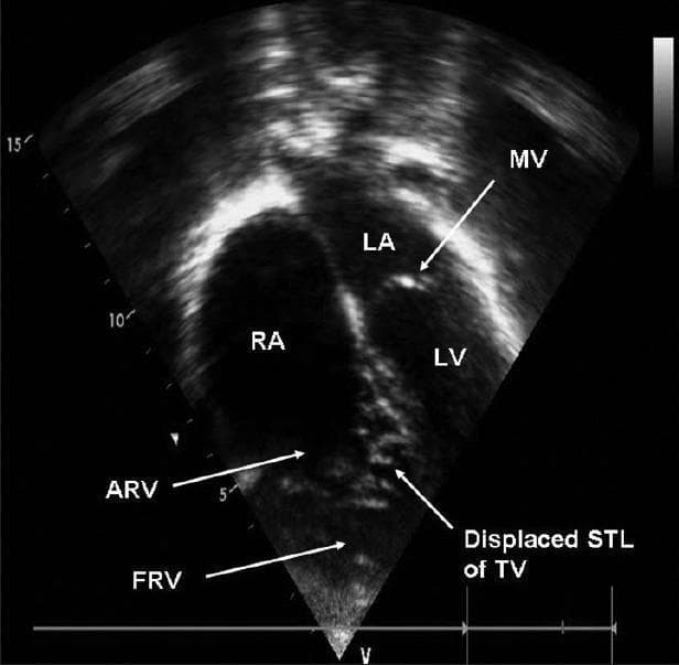 This diagnostic image is a transthoracic echocardiogram in an apical four-chamber view, demonstrating Ebstein’s anomaly of the tricuspid valve. The visual highlights a significant apical displacement of the septal tricuspid leaflet (STL) of the tricuspid valve (TV) relative to the mitral valve (MV). This displacement results in the 'atrialization' of the superior portion of the right ventricle (labeled as ARV - Atrialized Right Ventricle), which is functionally continuous with the right atrium (RA). The image also depicts the remaining functional right ventricle (FRV), which appears reduced in size due to the inferior displacement of the valve. Key anatomical landmarks labeled include the left atrium (LA), left ventricle (LV), and right atrium (RA). This imaging modality is essential for visualizing the structural and spatial rearrangement characteristic of congenital tricuspid valve malformations. The clinical significance of this finding relates to the assessment of right heart hemodynamics and the degree of functional impairment in pediatric and adult congenital heart disease.