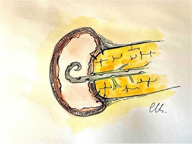 This medical illustration depicts a completed Robotic-assisted minimally invasive Pancreaticojejunostomy (RmPJ) anastomosis. The diagram showcases the surgical union between the transected pancreas (yellow structure) and the jejunum (pink circular structure). A central pancreatic duct is visible with a grey drainage stent in place, ensuring ductal patency. The anastomosis is constructed using an invaginating technique, specifically an outer anterior layer where the jejunal seromuscular wall is rolled over the pancreatic parenchyma. Visible dark sutures are placed at regular intervals along the anterior and posterior margins, demonstrating a continuous running barbed suture technique. This surgical approach is commonly utilized in pancreaticoduodenectomy (Whipple procedure) to manage the pancreatic remnant and mitigate the risk of postoperative pancreatic fistula. The illustration highlights key anatomical relationships including the pancreatic capsule, parenchyma, and the layered wall of the small intestine during reconstructive abdominal surgery.