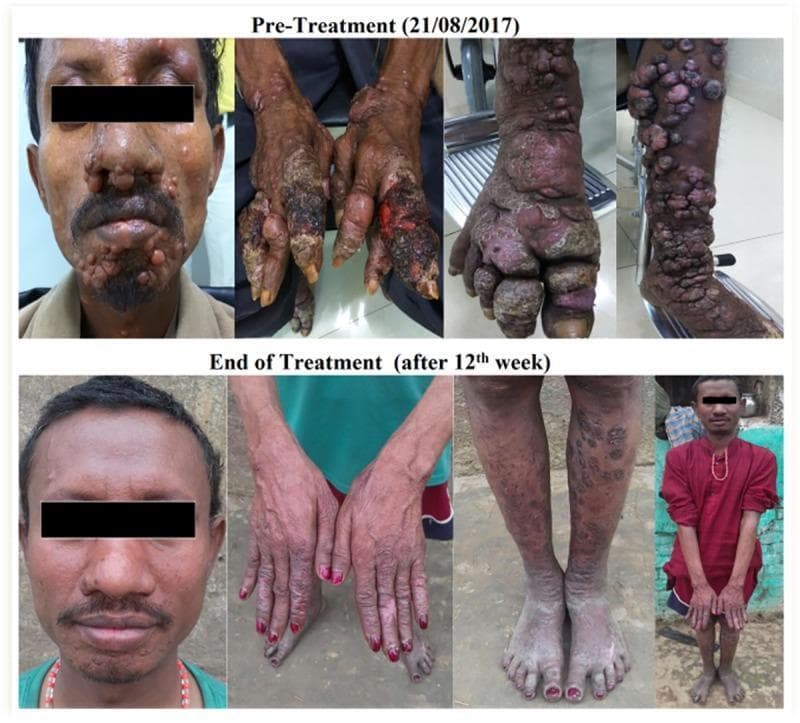 A series of clinical photographs presenting a comparison of a male patient with Post-Kala-azar Dermal Leishmaniasis (PKDL) before and after a 12-week treatment period. The 'Pre-Treatment' row shows extensive dermatological manifestations including multiple nodular lesions concentrated on the face (chin, nose, and cheeks), severely ulcerated and crusting lesions on the dorsal hands and fingers, and densely packed papulo-nodular eruptions on the lower extremities and feet, demonstrating a high disease burden. The 'End of Treatment' row illustrates significant clinical improvement across all anatomical regions. Facial nodules have resolved, leaving smoother skin with residual post-inflammatory hyperpigmentation. The ulcerated lesions on the hands have healed, showing improved skin integrity. The lower limbs exhibit a marked reduction in the size and quantity of papules, with the remaining lesions appearing flattened and less inflamed. This visual documentation serves as an educational tool for identifying the nodular and ulcerative subtypes of PKDL and monitoring the therapeutic response in a tropical medicine context.