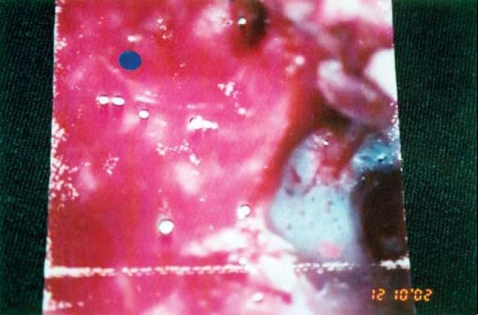 A clinical transoperative photograph depicting a modified radical mastoidectomy in a patient with cholesteatoma of the external auditory canal (CEAC). The surgical field shows the mastoid cavity with evident erosion of the posterior wall of the external auditory canal (EAC). Key anatomical features include an intact tympanic membrane (TM) and a preserved thin bone band near the tympanic ring. The photograph demonstrates the moist, erythematous surface of the middle ear and mastoid structures, with visible white bony landmarks and reddish soft tissue typical of surgical exploration for cholesteatoma management. The image is framed by green surgical draping, and a digital timestamp is visible in the lower right corner. This visual serves to illustrate the intraoperative findings and surgical extent required to manage extensive mastoid involvement while preserving the ossicle chain and facial nerve integrity.
