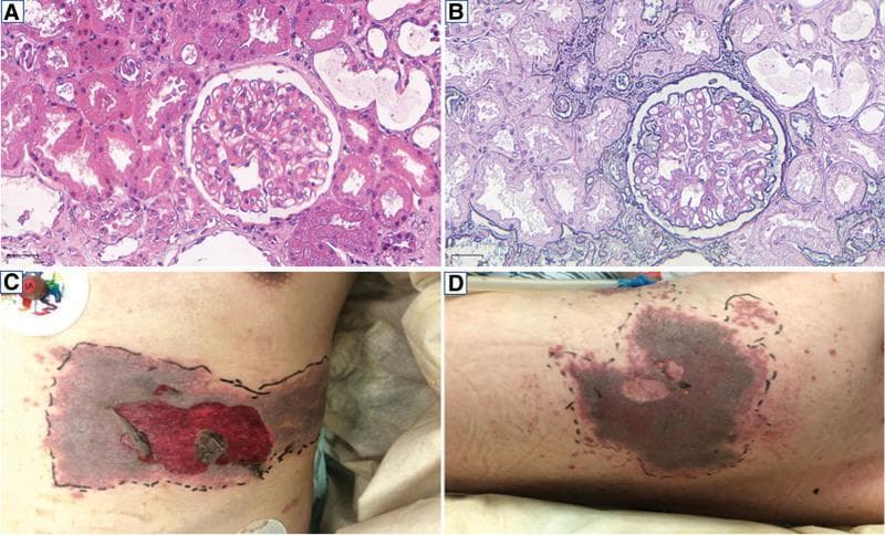 A multi-panel figure containing light microscopy of renal tissue and clinical photographs of dermatological lesions. Panels A and B display renal biopsy specimens at 200x magnification. Image A (Hematoxylin and Eosin stain) shows a glomerulus with mild-to-moderate hypercellularity and mesangial matrix expansion, consistent with lupus nephritis. Image B (Periodic Acid-Schiff stain) highlights the basement membranes and mesangium, demonstrating immune complex deposits in the subendothelial and mesangial regions. Surrounding renal tubules show varying degrees of epithelial changes. Panels C and D are clinical photographs of a patient with systemic lupus erythematosus showing a severe, clustered vesicular rash on the left hypochondrium (C) and left back (D). The lesions exhibit significant confluence, dark necrotic or hemorrhagic centers, and evidence of ruptured vesicles. The affected areas are demarcated by black ink for clinical monitoring, suggesting a dermatomal distribution characteristic of herpes zoster (shingles) occurring in an immunocompromised state. These images collectively illustrate the renal manifestations of SLE and a subsequent secondary viral opportunistic infection.