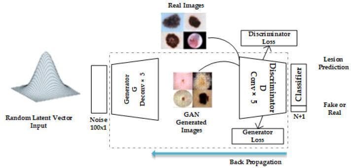 This flow diagram illustrates a Deep Convolutional Generative Adversarial Network (DCGAN) architecture specifically designed for skin lesion classification. The process initiates with a 'Random Latent Vector Input' represented by a Gaussian distribution curve, which is transformed into a 'Noise 100x1' vector. This noise enters a 'Generator (G)' consisting of five deconvolutional layers ('Deconv x 5'). The generator produces synthetic 'GAN Generated Images' depicting various skin lesions. Simultaneously, 'Real Images' (clinical dermatoscopic photographs of benign and malignant lesions) are provided from a training dataset. Both real and generated images serve as inputs for a 'Discriminator (D)' utilizing five convolutional layers ('Conv x 5'). The discriminator computes 'Discriminator Loss' and 'Generator Loss' to facilitate 'Back Propagation' for model optimization. Finally, the network utilizes a 'Classifier' to distinguish between 'Fake or Real' images and provide a 'Lesion Prediction.' This architecture is an advanced diagnostic imaging tool aimed at improving dermatological classification through data augmentation and deep learning.