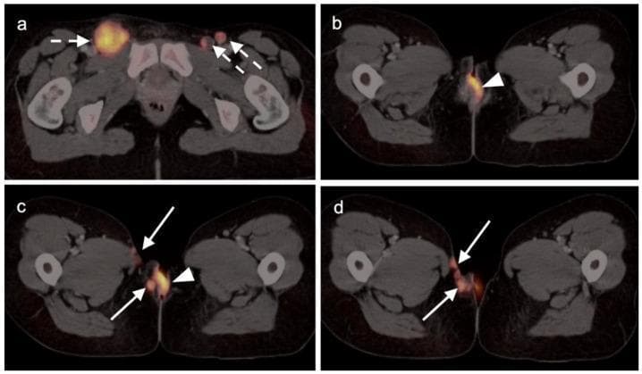 This composite diagnostic image features four axial FDG PET-CT scans (a-d) of the female pelvis demonstrating vulvar squamous cell carcinoma with metastatic spread. Image (a) shows bilateral inguinal lymphadenopathy with intense hypermetabolism; white dashed arrows highlight the metabolic activity in the right and left inguinal regions. Images (b), (c), and (d) focus on the primary vulvar carcinoma (white arrowheads), which exhibits marked FDG uptake. Progression through the axial slices (c and d) reveals local invasion of the malignancy into the adjacent right-sided subcutaneous tissue and the skin of the right medial thigh (indicated by solid white arrows). This diagnostic series illustrates the staging utility of PET-CT in identifying both the hypermetabolic primary tumor and regional nodal involvement in gynecologic oncology. The visual evidence emphasizes the typical patterns of local spread and lymphatic drainage associated with advanced vulvar malignancies.