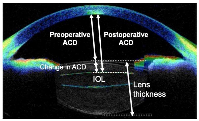 This diagnostic image is an anterior segment optical coherence tomography (AS-OCT) scan of a human eye, specifically capturing a cross-sectional view of the anterior chamber, cornea, and lens. The image serves as a clinical diagram to illustrate biometric changes following cataract surgery. High-contrast annotations and white arrows denote key anatomical measurements: Preoperative Anterior Chamber Depth (ACD) measured from the posterior corneal surface to the anterior lens capsule; Postoperative ACD measured to the anterior surface of the Intraocular Lens (IOL); and the 'Change in ACD' representing the shift in position. Additionally, 'Lens Thickness' is delineated by the distance between the anterior and posterior lens surfaces. The pseudocolor heat map displays the cornea and sclera in shades of blue and green, while the iris and lens structures show varying levels of reflectivity. This visual is intended for ophthalmic education regarding surgical outcomes, IOL positioning, and anterior chamber morphometry.