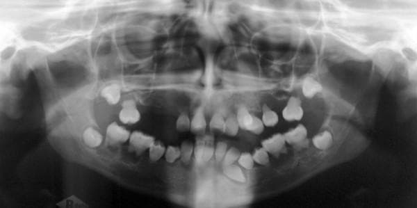 A panoramic radiograph (orthopantomogram) of the maxilla and mandible demonstrating pathognomonic features of Dentin Dysplasia Type I. The primary diagnostic finding is a striking absence of root development (radicular dysplasia) across both the primary and permanent dentition, with teeth appearing as 'rootless' crowns. While the visible dental crowns maintain relatively normal morphology, pulp chambers are obliterated or significantly reduced. Multiple periapical radiolucencies are visible, consistent with spontaneous periapical cysts or inflammatory lesions occurring in the absence of obvious caries. The image further shows several impacted and retained teeth (including the third molars and lower left canine) and congenitally missing teeth in the maxillary quadrants. Structurally, the maxilla and mandible exhibit vertical and sagittal underdevelopment, contributing to an abnormal alveolar ridge profile. This diagnostic image illustrates a rare hereditary dentin defect relevant to pediatric dentistry, oral pathology, and maxillofacial surgery.